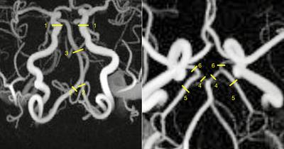 Hemodynamic Disturbances in Posterior Circulation Stroke: 4D Flow Magnetic Resonance Imaging Added to Computed Tomography Angiography